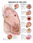 Diseases-of-the-Lung-anatomical-chart